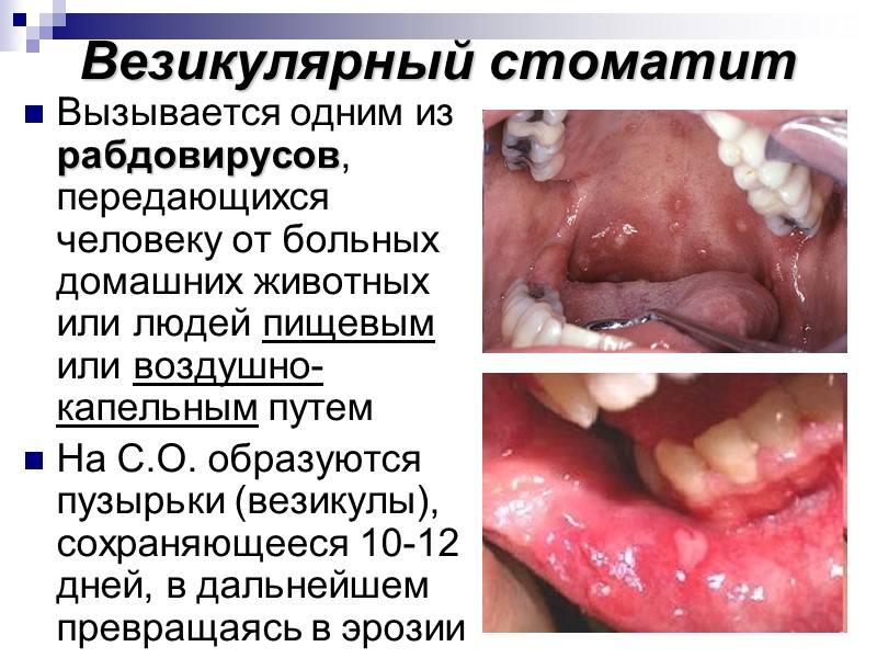 Везикулярный стоматит Вызывается одним из рабдовирусов,  передающихся человеку от больных домашних животных или